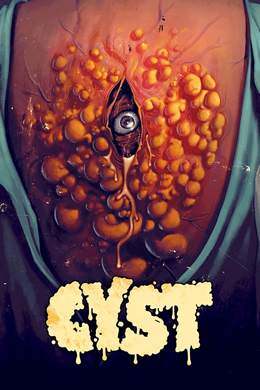  Mordercza cysta 